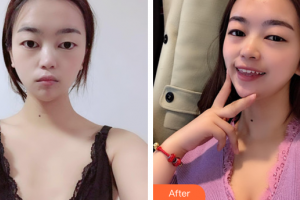 廣州解放軍第四五八醫(yī)院激光整形美容中心鄒吉平整形價(jià)格表附自體脂肪隆胸案例展示