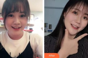 漳州衛(wèi)生職業(yè)學(xué)院附屬口腔醫(yī)院鄧潔如整形價格表附金屬托槽矯正案例展示