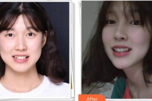 漳州佳美口腔門診部鄧少卿整形價格表附牙齒隱形托槽矯正案例展示