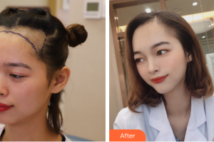 廣州雍禾植發(fā)門(mén)診部汪軍整形價(jià)格表附種植發(fā)際線案例展示