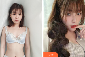 廣州慕美醫(yī)療美容醫(yī)院蕭嘉住院醫(yī)師整形價(jià)格表附自體脂肪隆胸案例展示