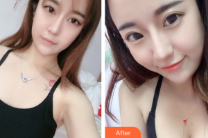 廣州伊麗莎白醫(yī)學(xué)美容門(mén)診部明皓整形價(jià)格表附自體脂肪隆胸案例展示