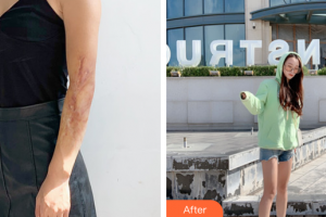 廣州中科美整形醫(yī)院徐思思整形價(jià)格表附手臂疤痕案例展示