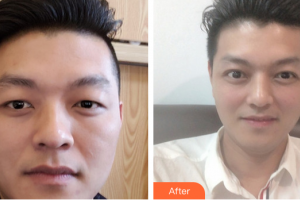 廣州博研醫(yī)療美容門(mén)診部吳良才整形價(jià)格表附切開(kāi)雙眼皮案例展示