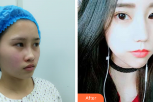 廣州柏美醫(yī)學(xué)美容醫(yī)院Jackyxu整形價(jià)格表附埋線提升案例展示