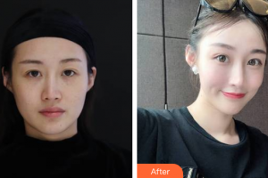 廣州凱美達(dá)整形美容醫(yī)院周玲整形價(jià)格表附熱瑪吉抗衰案例展示