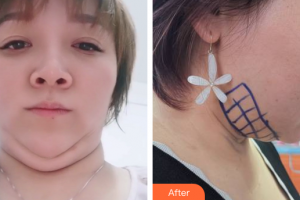 廣州壹加壹美容醫(yī)院王大勇整形價(jià)格表附面部輪廓案例展示