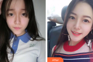 廣州藝美醫(yī)療美容門(mén)診部張濤整形價(jià)格表附雙眼皮0案例展示