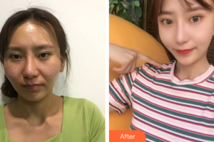 廣州拜博醫(yī)療美容門(mén)診部薛國(guó)初整形價(jià)格表附顴骨顴弓整形案例展示