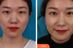 廣州愛(ài)來(lái)（原阿瑪施）醫(yī)療美容整形醫(yī)院孫愷整形價(jià)格表附雙眼皮案例展示