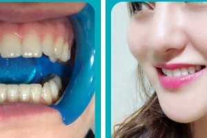 漳州佳美口腔門診部范美金整形價格表附牙齒美白案例展示