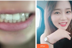 漳州佳美口腔門診部吳日耀整形價格表附金屬托槽矯正案例展示