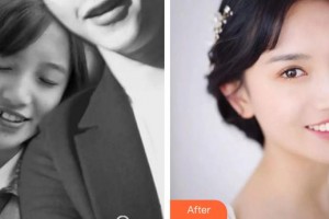 漳州佳美口腔門診部童斌斌整形價格表附金屬托槽矯正案例展示