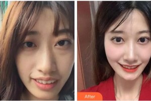 漳州衛(wèi)生職業(yè)學(xué)院附屬口腔醫(yī)院安厚鵬整形價格表附牙齒矯正案例展示