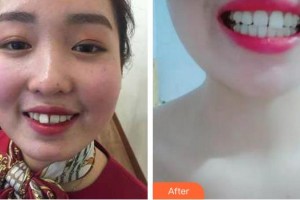 漳州衛(wèi)生職業(yè)學(xué)院附屬口腔醫(yī)院郭燦華整形價格表附隱形矯正案例展示