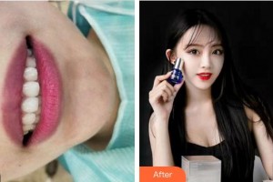 漳州南健口腔門診部田少惠整形價格表附牙齒矯正案例展示