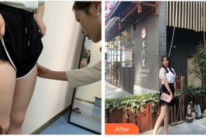 南平時光醫(yī)療美容門診部周偉整形價格表附大腿吸脂案例展示