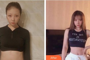 南平市第一醫(yī)院燒傷整形科黃道強(qiáng)整形價(jià)格表附疤痕案例展示