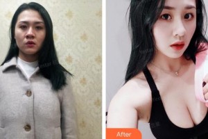 龍巖歐菲醫(yī)療美容門(mén)診部黃朝暉整形價(jià)格表附假體豐胸案例展示