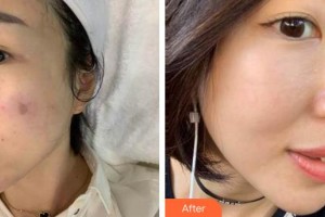 龍巖華美醫(yī)療美容醫(yī)院盧云整形價(jià)格表附激光美膚激光案例展示