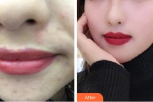 龍巖華美醫(yī)療美容醫(yī)院劉春鳳整形價(jià)格表附激光美膚嫩膚案例展示