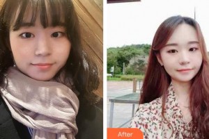 龍巖歐菲醫(yī)療美容門(mén)診部劉燕整形價(jià)格表附激光美膚激光案例展示