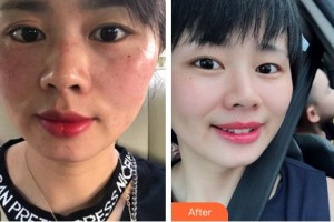 龍巖博愛(ài)醫(yī)院整形美容中心林珍娘整形價(jià)格表附超激光美膚案例展示