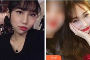 龍巖華美醫(yī)療美容醫(yī)院黃梅麗整形價(jià)格表附激光美膚祛斑案例展示