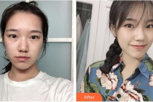 龍巖人民醫(yī)院燒傷整形科熊建華整形價(jià)格表附疤痕案例展示