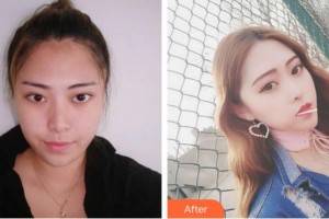 寧德442醫(yī)院整形美容中心趙巖整形價(jià)格表附可愛(ài)多變美日記案例展示