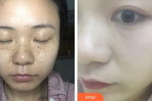 寧德442醫(yī)院整形美容中心姜敏整形價(jià)格表附超激光美膚祛斑案例展示