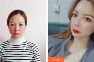 寧德東韓整形美容醫(yī)院聶艷武整形價(jià)格表附熱瑪吉案例展示