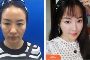 寧德東韓整形美容醫(yī)院莊載世整形價(jià)格表附埋線(xiàn)提升案例展示