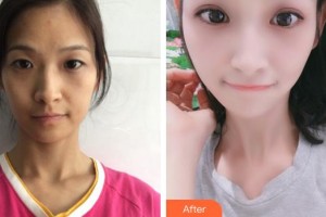 寧德眼科醫(yī)院林寬添整形價(jià)格表附眼部綜合案例展示