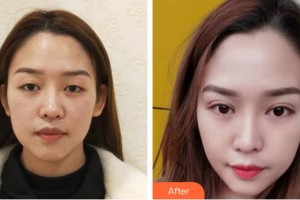 寧德眼科醫(yī)院蘇宗平整形價(jià)格表附眼部整形案例展示