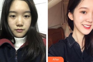 寧德眼科醫(yī)院李小霞整形價(jià)格表附雙眼皮+開(kāi)眼角+提肌案例展示