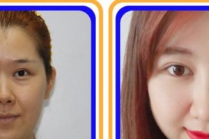 寧德眼科醫(yī)院范圣麗整形價(jià)格表附眼部綜合案例展示