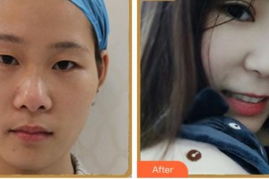 寧德愛爾眼科醫(yī)院郭如汾整形價(jià)格表附眼部多項(xiàng)案例展示