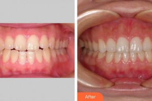 寧德中富口腔醫(yī)院王琳勇整形價(jià)格表附牙綜合案例展示