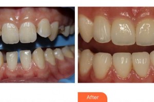 寧德中富口腔醫(yī)院楊順整形價(jià)格表附隱形托槽矯正案例展示