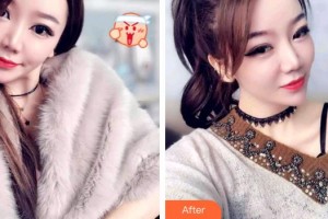 寧德中富口腔醫(yī)院楊登整形價(jià)格表附牙齒隱形矯正案例展示