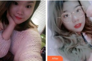 寧德中富口腔醫(yī)院謝曉婷整形價(jià)格表附牙齒隱形矯正案例展示