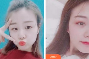 安徽立新醫(yī)學美容門診部周著祖整形價格表附雙眼皮案例展示