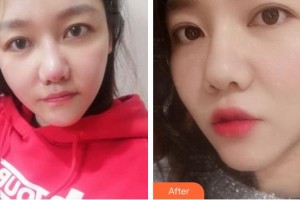 安徽韓美整形美容醫(yī)院蔣炎春整形價格表附埋線提升案例展示