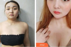 安徽維多利亞整形外科醫(yī)院盛宗順整形價格表附濃縮豐胸案例展示