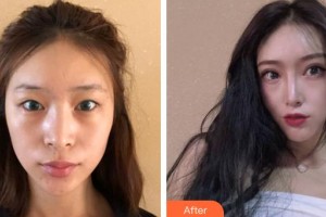 安徽立新醫(yī)學美容門診部朱慧茹整形價格表附切開雙眼皮案例展示