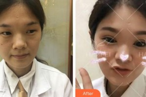 安徽立新醫(yī)學美容門診部李鐘輝整形價格表附雙眼皮案例展示