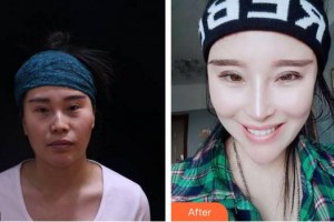 安徽立新醫(yī)學美容門診部李戰(zhàn)強整形價格表附鼻部手術案例展示