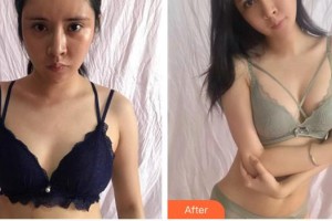 安徽醫(yī)科大學第二附屬醫(yī)院整形美容中心曹東升整形價格表附隆胸案例展示