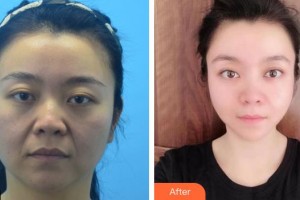 安徽立新醫(yī)學美容門診部楊鵬整形價格表附埋線提升案例展示